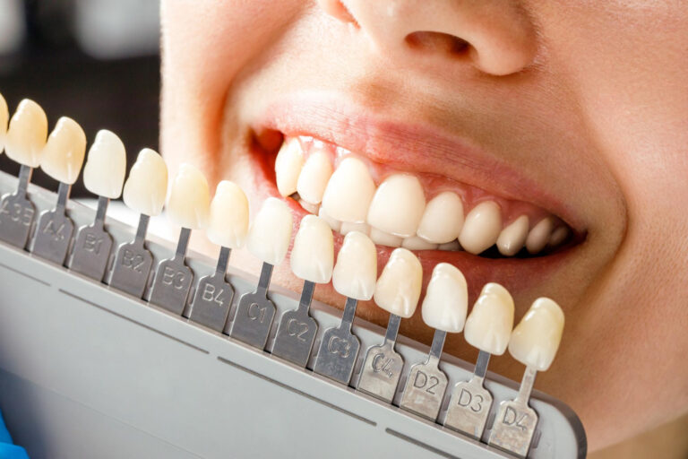 Faccette Dentali