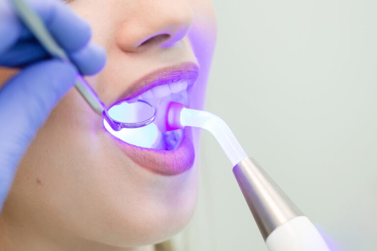 Sbiancamento Denti