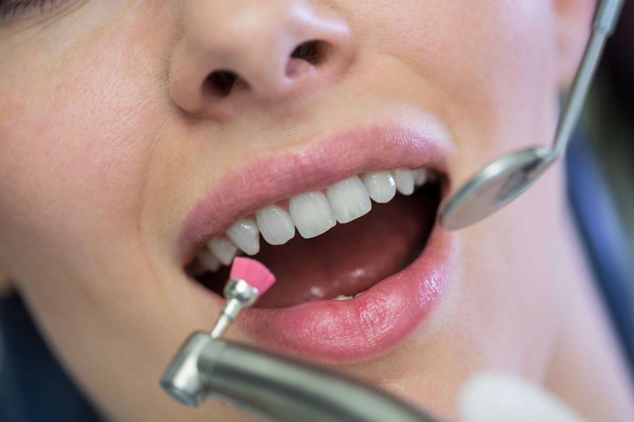 Sbiancamento Dental Roma Acilia Axa